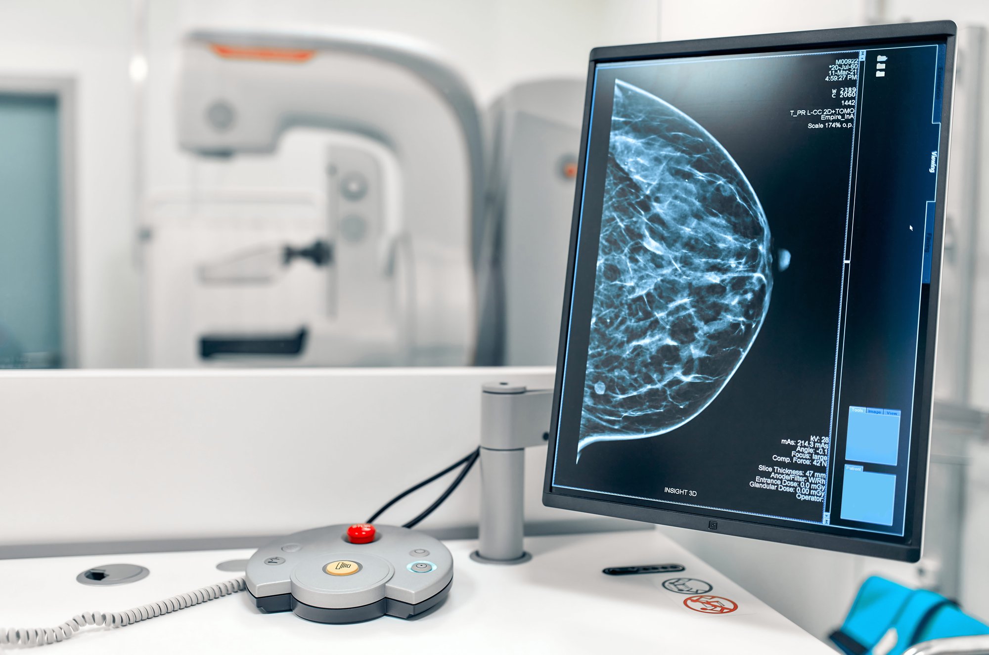 mammogram-image-on-screen-in-a-medical-setting-2026-09-22-03-24-45-utc (1)